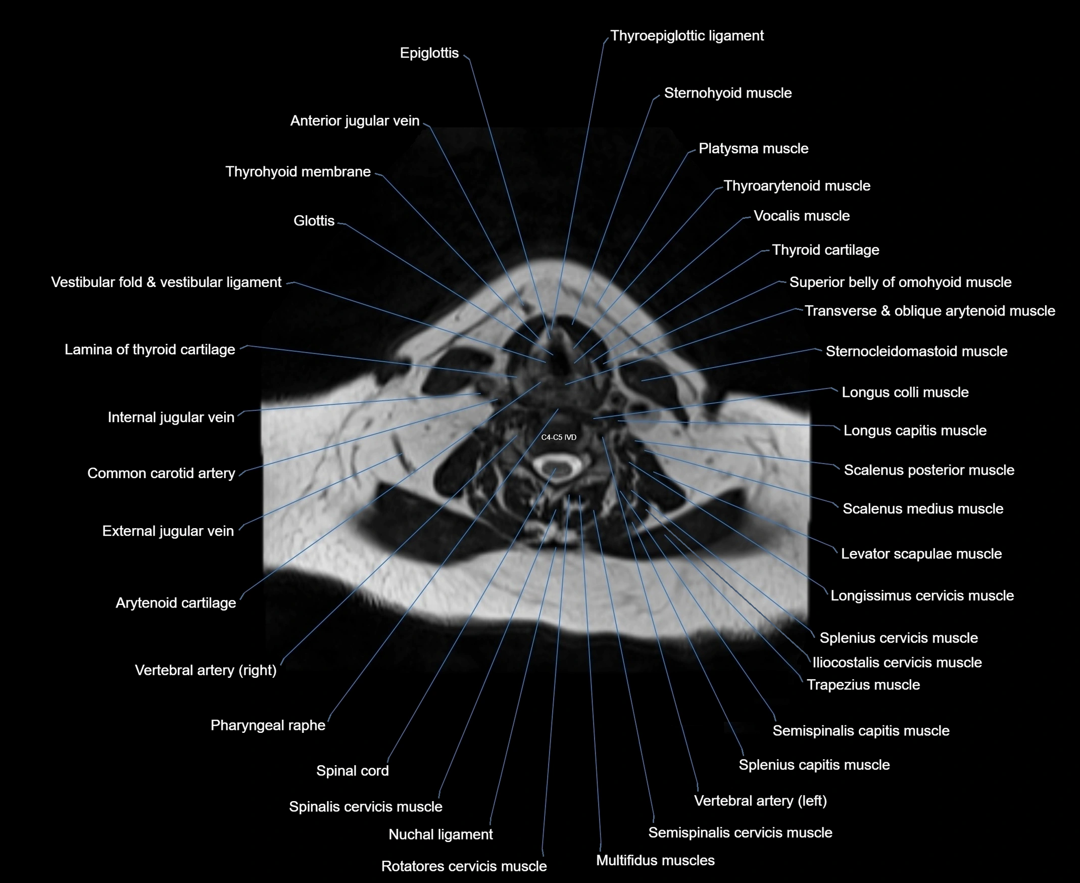 MRI Neck 3D labelled cross section anatomy axial 3t image-00001-00058.webp